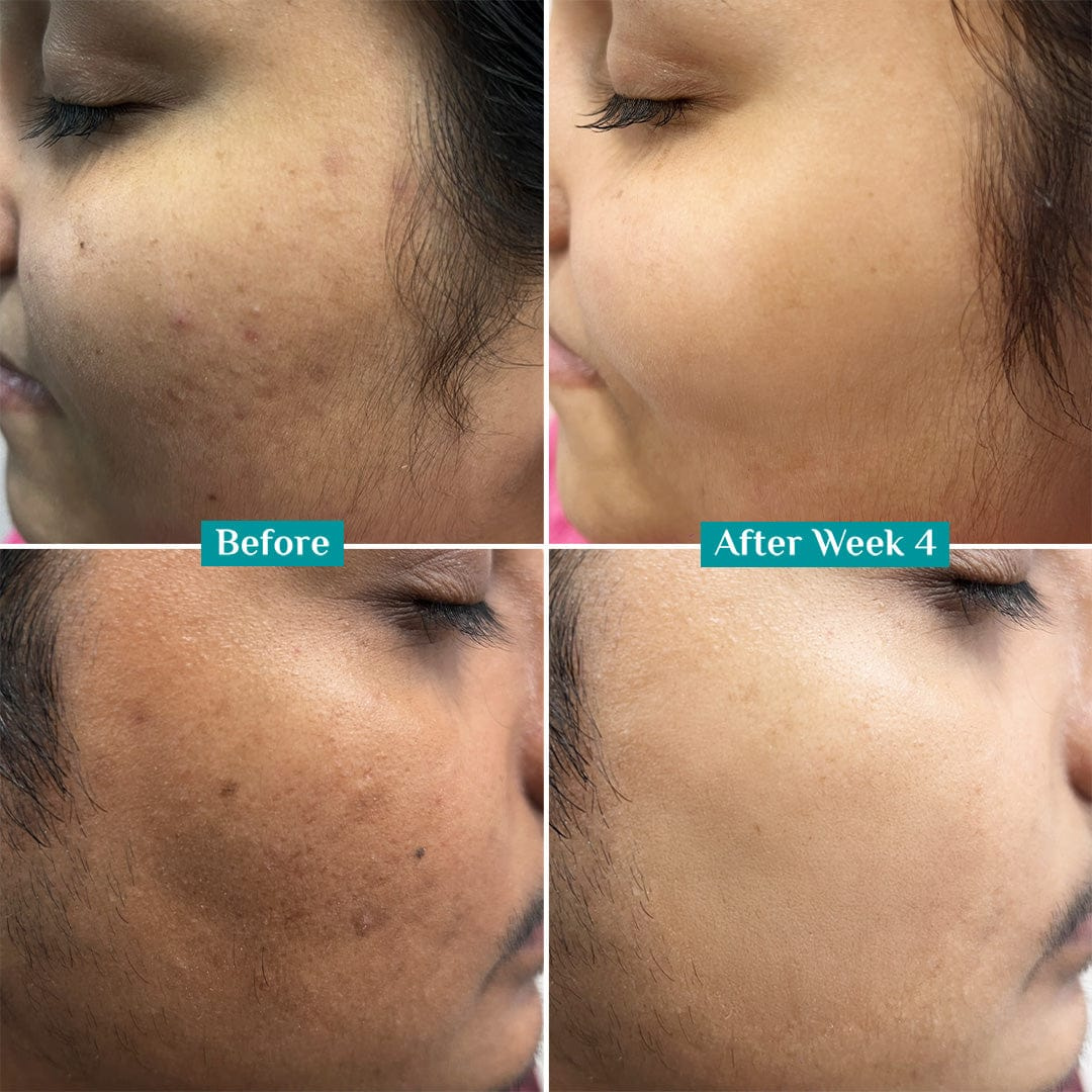Teashell Niacinamide Brightening Serum |BUY ONE GET ONE FREE/ Fades Dark Spots, Evens Skin Tone & Boosts Glow